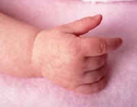 Алергічний дерматит у немовляти: причини появи захворювання, лікування