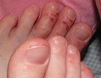 درماتیت آلرژیک در پاهای بزرگسالان: عکس، درمان