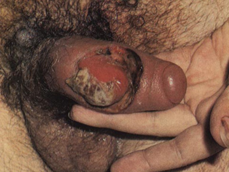 третичный сифилис на половых органах